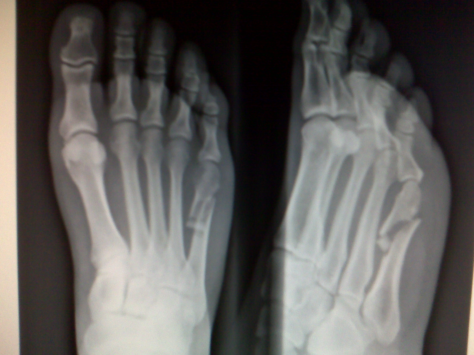 080425-lindas-broken-foot1.jpg